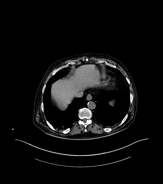 File:Cholangiocarcinoma with cerebral metastases (Radiopaedia 83519-98629 Axial non-contrast 9).jpg
