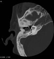 Cholesteatoma (Radiopaedia 5467-7197 Axial bone window 2).jpg