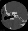Cholesteatoma (Radiopaedia 5467-7197 Coronal bone window 13).jpg