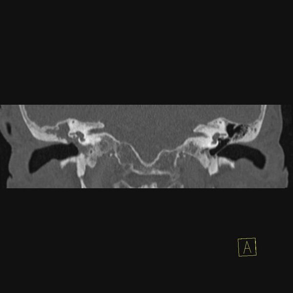 File:Cholesteatomatous chronic otitis (Radiopaedia 14993-14911 Coronal bone window 8).JPEG