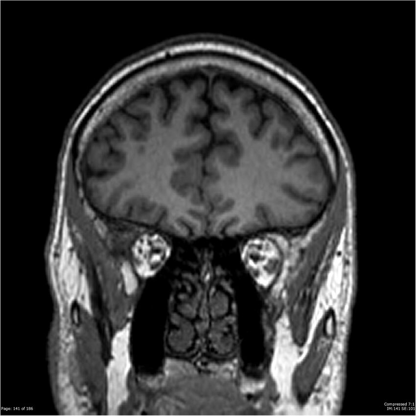 Chondrosarcoma of skull base- grade II (Radiopaedia 40948-43654 Coronal T1 62).jpg