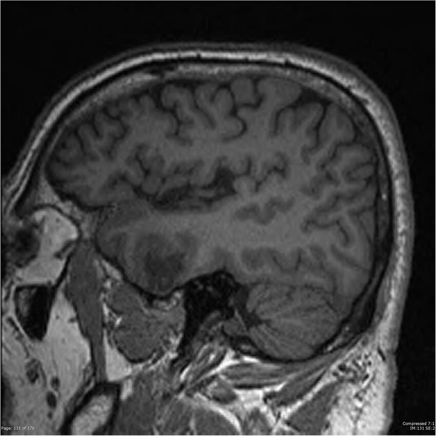 Chondrosarcoma of skull base- grade II (Radiopaedia 40948-43654 Sagittal T1 54).jpg