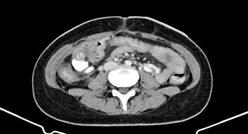 File:Choriocarcinoma liver metastases (Radiopaedia 74768-85766 A 123).jpg