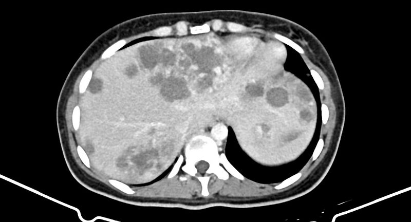 File:Choriocarcinoma liver metastases (Radiopaedia 74768-85766 A 36).jpg