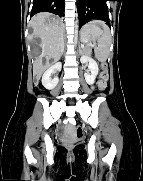 File:Choriocarcinoma liver metastases (Radiopaedia 74768-85766 B 66).jpg