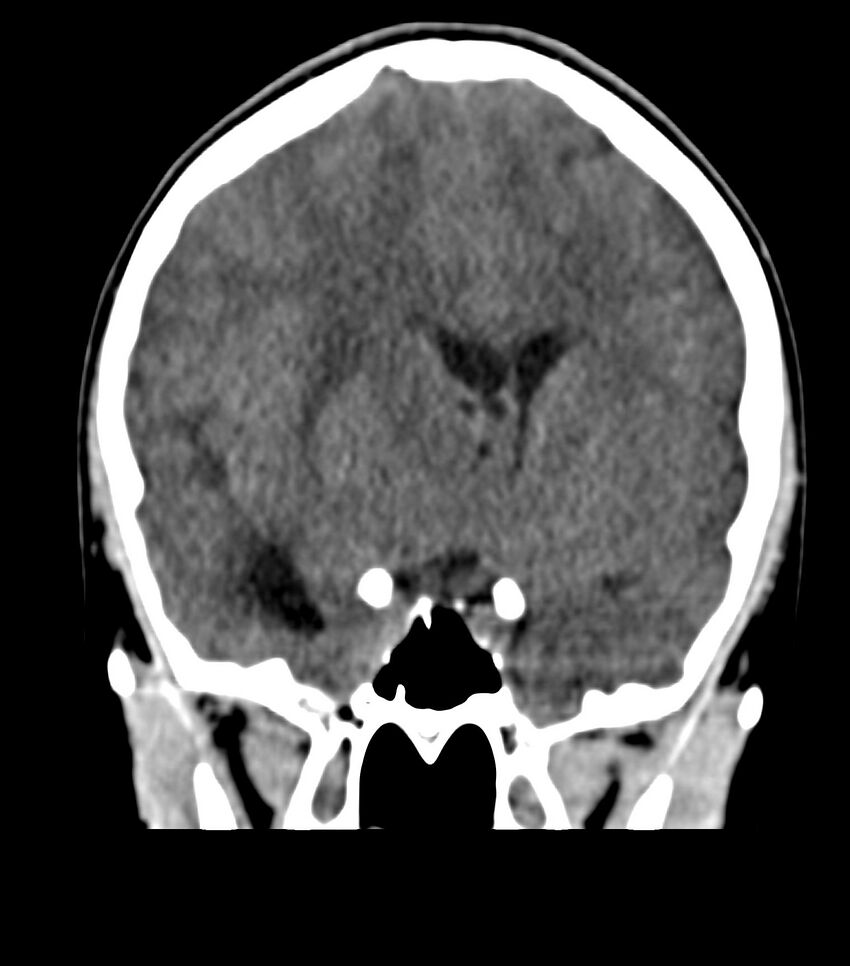 Choroid plexus carcinoma (Radiopaedia 91013-108552 Coronal non-contrast 35).jpg
