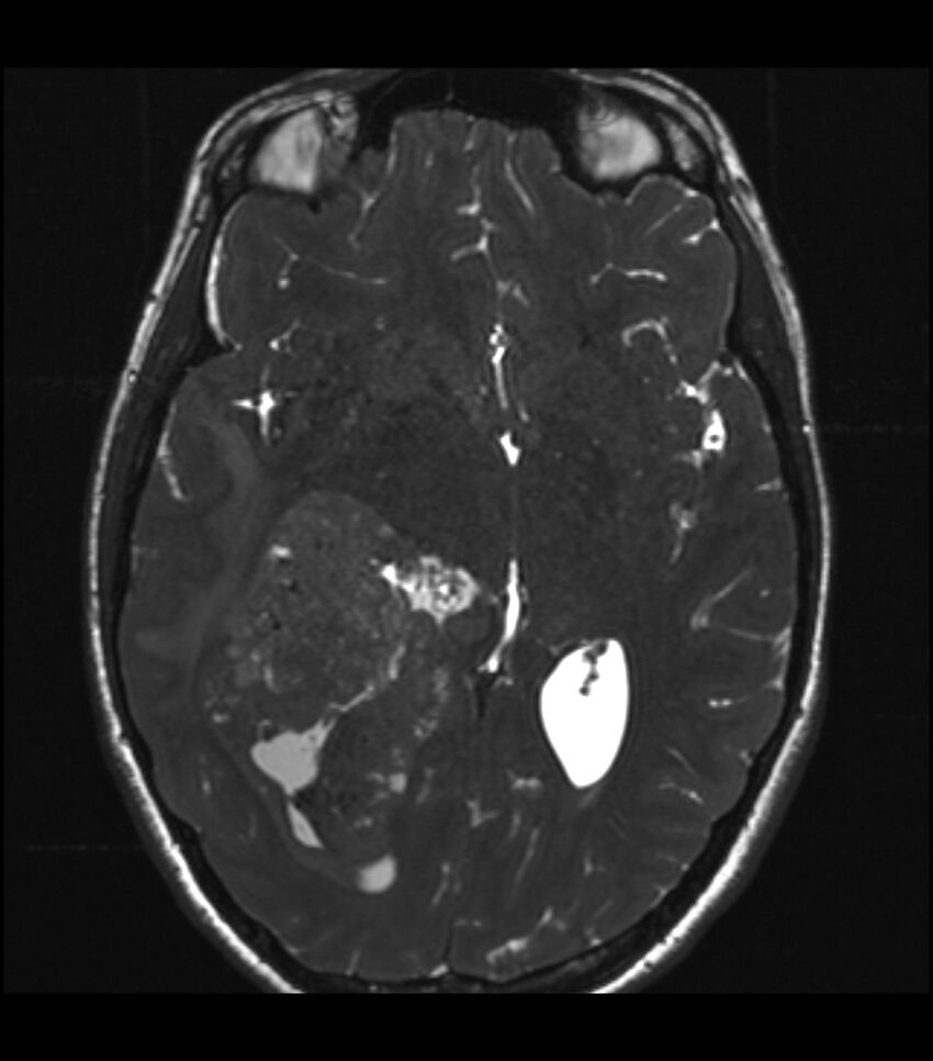 Choroid plexus carcinoma (Radiopaedia 91013-108553 Axial T2 CISS 38).jpg