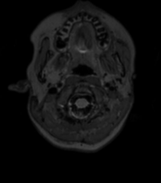 File:Choroid plexus carcinoma (Radiopaedia 91013-108553 Axial T2 fat sat 23).jpg