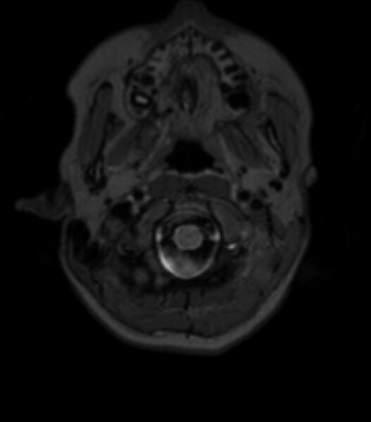 File:Choroid plexus carcinoma (Radiopaedia 91013-108553 Axial T2 fat sat 26).jpg