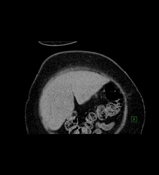 File:Chromophobe renal cell carcinoma (Radiopaedia 84239-99519 C 11).jpg