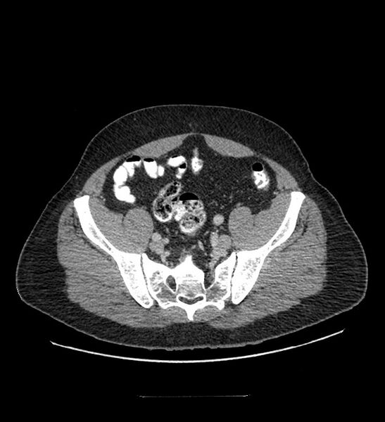 File:Chromophobe renal cell carcinoma (Radiopaedia 84337-99644 C 105).jpg