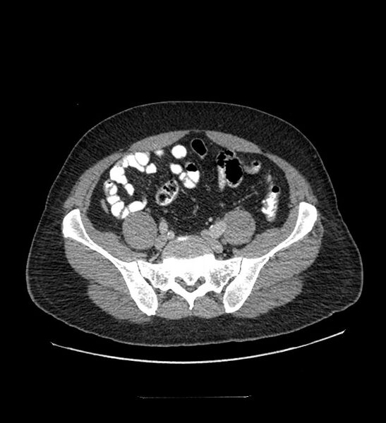 File:Chromophobe renal cell carcinoma (Radiopaedia 84337-99644 C 99).jpg