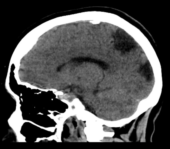 File:Chronic bilateral occipital lobe infarcts (Radiopaedia 31276-31996 C 18).jpg