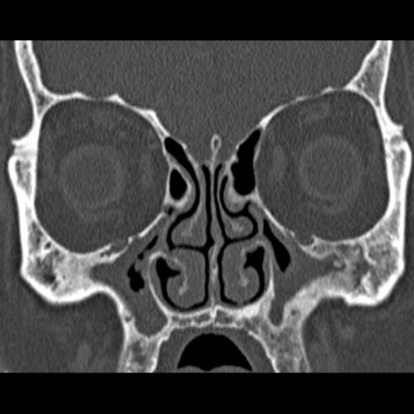 File:Chronic maxillary sinusitis (Radiopaedia 27879-28116 Coronal bone window 21).jpg