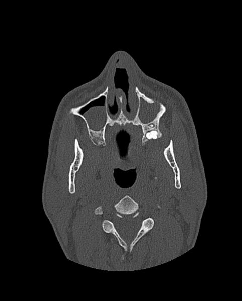 File:Chronic maxillary sinusitis caused by a foreign body (Radiopaedia 58521-65676 Axial bone window 70).jpg