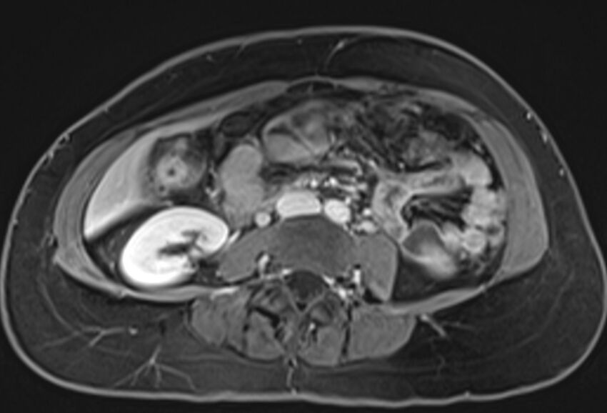 Chronic pancreatitis - pancreatic duct calculi (Radiopaedia 71818-82250 Axial T1 C+ fat sat 47).jpg
