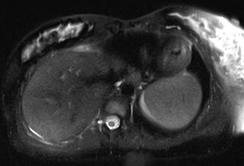 File:Chronic pancreatitis - pancreatic duct calculi (Radiopaedia 71818-82250 Axial T2 fat sat 8).jpg