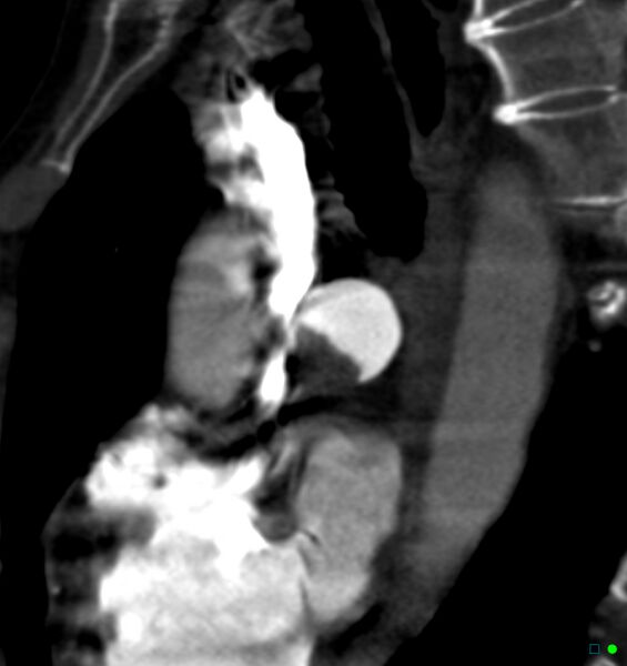 File:Chronic pulmonary embolism (Radiopaedia 17943-17702 Sagittal C+ CTPA 2).jpg