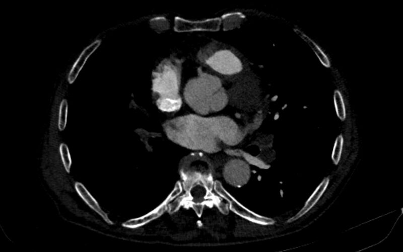 File:Chronic pulmonary embolism (Radiopaedia 91241-108843 B 111).jpg
