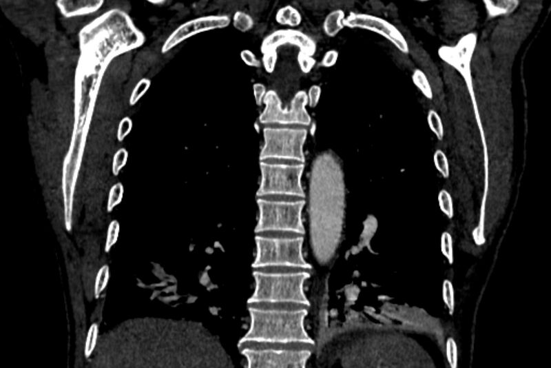 File:Chronic pulmonary embolism with bubbly consolidation (Radiopaedia 91248-108850 B 108).jpg