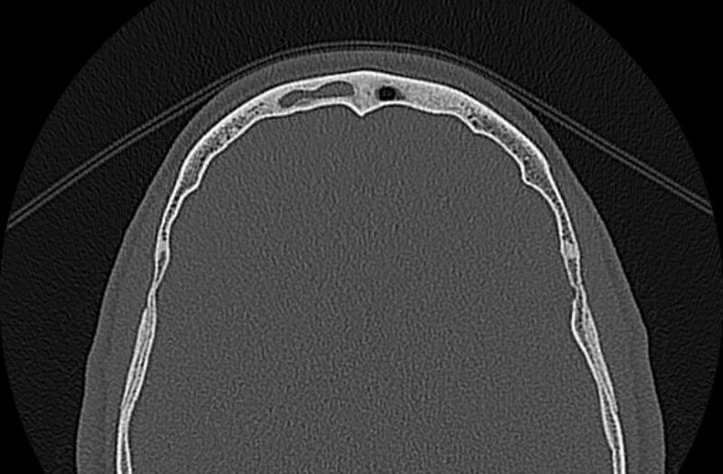 File:Chronic rhinosinusitis (Radiopaedia 65079-74075 Axial bone window 84).jpg