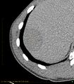 Chronic subcapsular hepatic hematoma (Radiopaedia 29548-30051 Axial C+ delayed 1).jpg