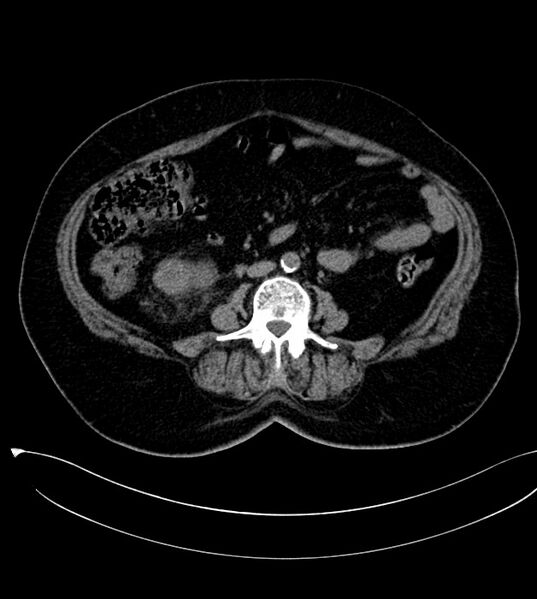 File:Clear cell renal cell carcinoma (Radiopaedia 85004-100537 Axial non-contrast 25).jpg