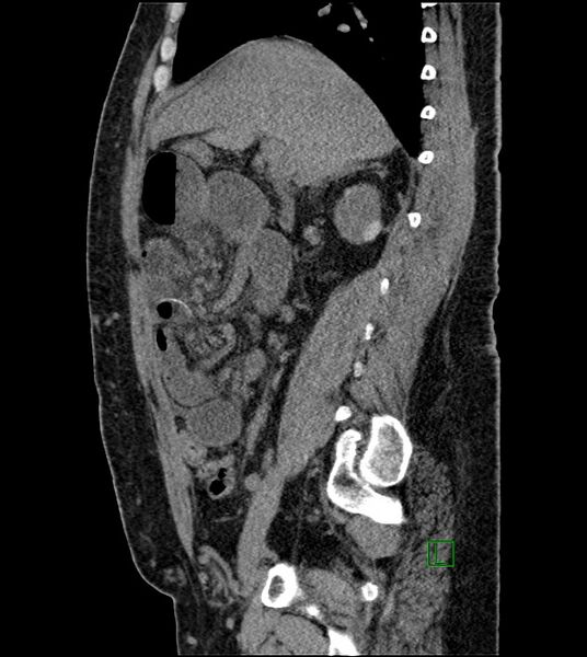 File:Closed-loop small bowel obstruction-internal hernia (Radiopaedia 78439-91096 C 92).jpg