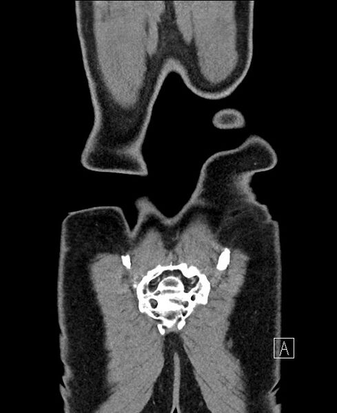 File:Closed loop small bowel obstruction - internal hernia (Radiopaedia 57806-64778 A 119).jpg