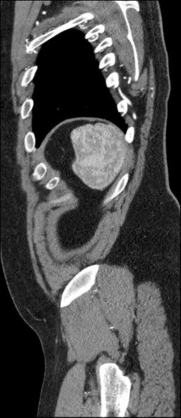 File:Coarctation of the aorta (Radiopaedia 74632-88521 C 292).jpg