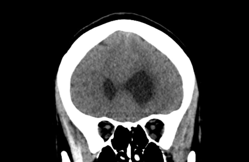Colloid cyst (Radiopaedia 53180-59146 Coronal non-contrast 19).jpg