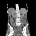 Colocolic fistula - Crohn disease (Radiopaedia 57063-63955 B 28).jpg
