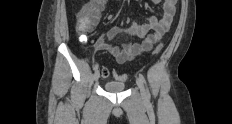 File:Colocutaneous fistula (Radiopaedia 56401-63062 C 41).jpg