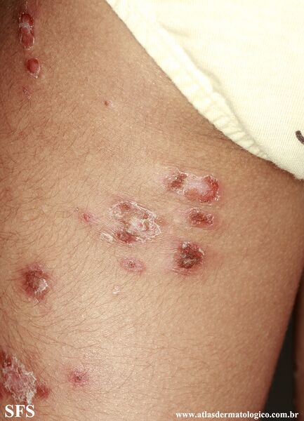 File:Impetigo (Dermatology Atlas 92).jpg