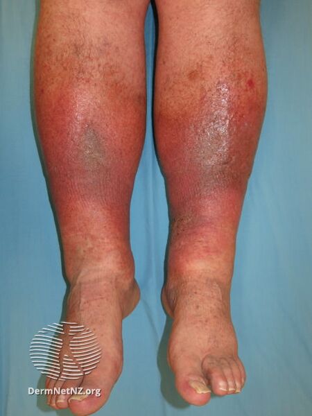File:Lipodermatosclerosis (DermNet NZ dermatitis-lipodermatosclerosis).jpg