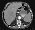 Liver cirrhosis (Radiopaedia 35973).jpg