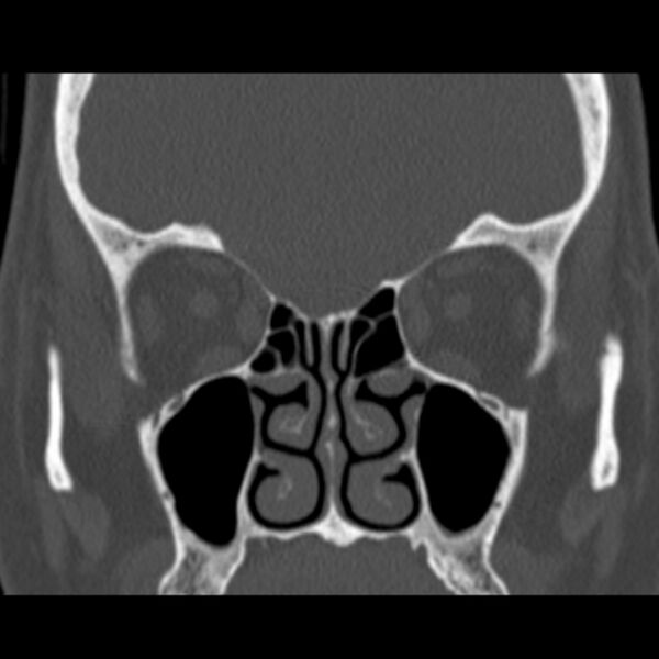 File:Nasolabial cyst (Radiopaedia 33987-35205 Coronal bone window 39).jpg