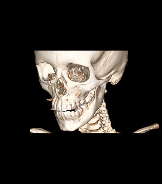 File:Nasoorbitoethmoid fracture (Radiopaedia 90044-107205 3D VRT 23).jpg