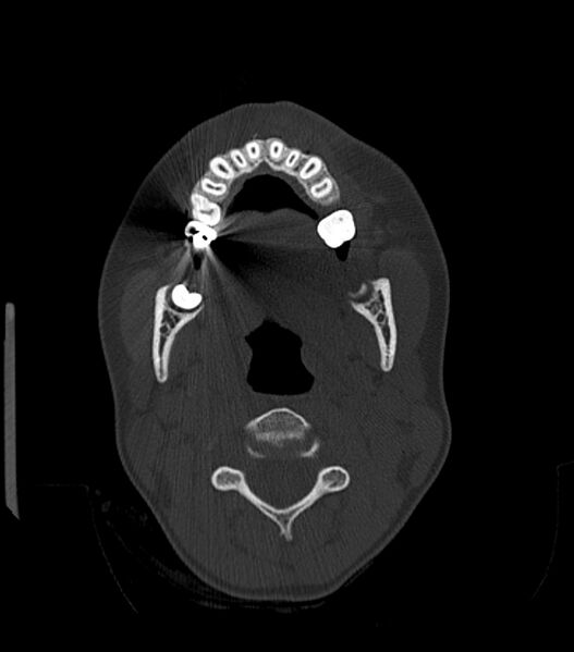 File:Nasoorbitoethmoid fracture (Radiopaedia 90044-107205 Axial bone window 42).jpg