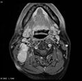 Nasopharyngeal carcinoma (Radiopaedia 4546-6667 Axial T1 C+ fat sat 20).jpg