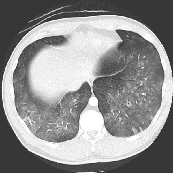 File:Near drowning pulmonary edema (Radiopaedia 16868-16591 Axial lung window 43).jpg