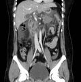 Necrotizing pancreatitis (Radiopaedia 23001-23031 B 32).jpg