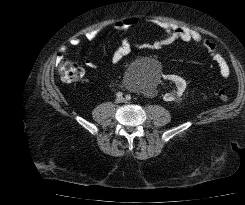 Nephroptosis with inguinal hernia containing perirenal fat (Radiopaedia 56632-63391 C 220).jpg