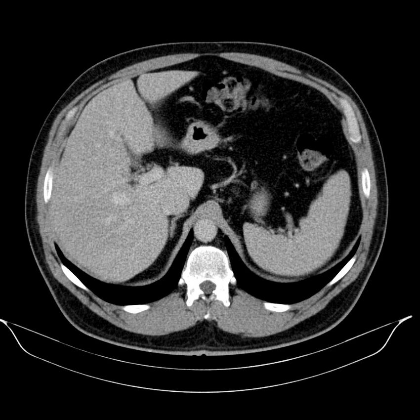 Neuroendocrine tumor of head of pancreas (Radiopaedia 57538-64502 D 22).jpg