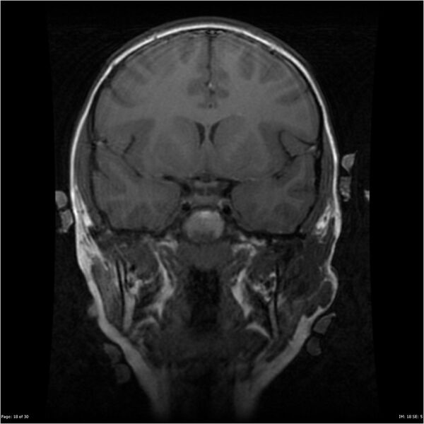 File:Neurofibromatosis type 1 (Radiopaedia 22541-22564 Coronal T1 27).jpg