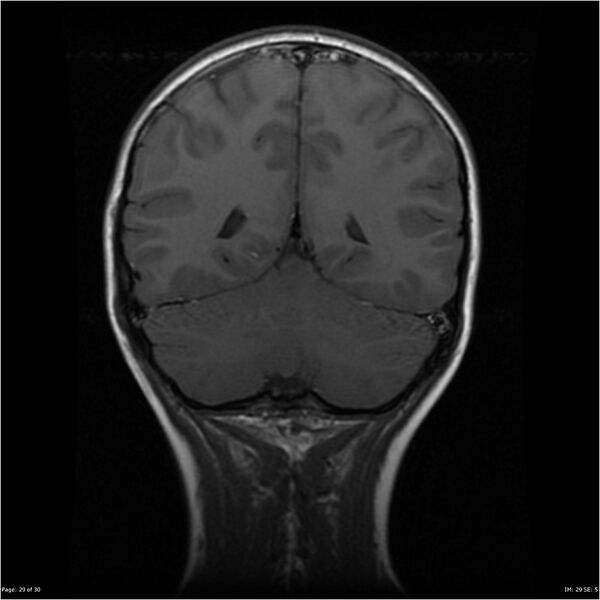File:Neurofibromatosis type 1 (Radiopaedia 22541-22564 Coronal T1 38).jpg
