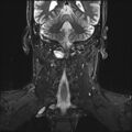 Neurofibromatosis type 1 (Radiopaedia 80355-93740 Coronal STIR 9).jpg