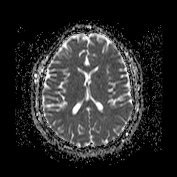 File:Neurofibromatosis type 2 (Radiopaedia 67470-76871 Axial ADC 14).jpg
