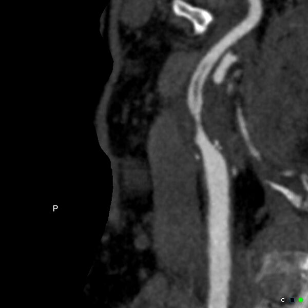 File:Non-occlusive intraluminal internal carotid artery thrombus (Radiopaedia 37751-39658 A 11).jpg
