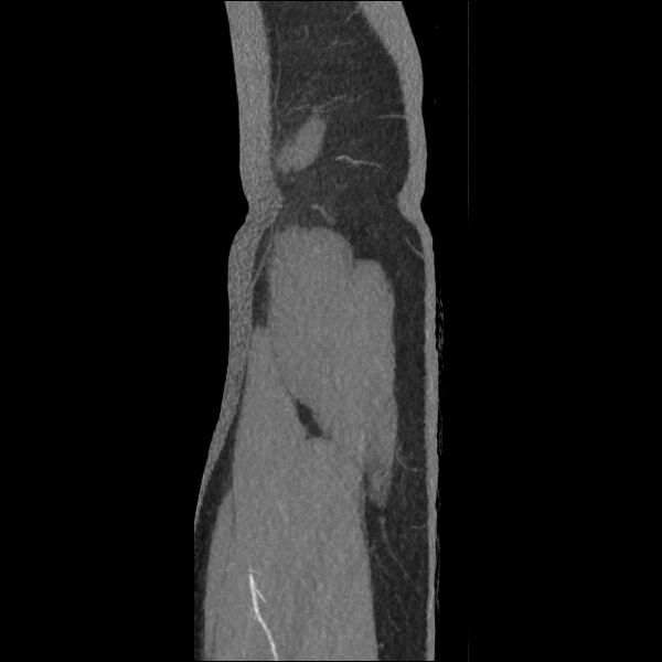 File:Normal CT angiogram of pelvis (Radiopaedia 45390-49430 C 5).jpg